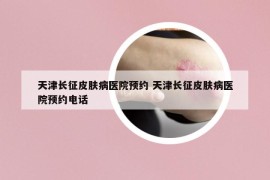 天津长征皮肤病医院预约 天津长征皮肤病医院预约电话