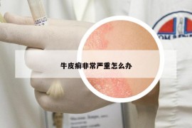 牛皮癣非常严重怎么办