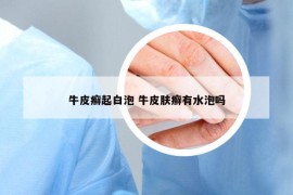 牛皮癣起白泡 牛皮肤癣有水泡吗