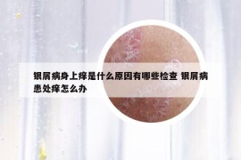 银屑病身上痒是什么原因有哪些检查 银屑病患处痒怎么办
