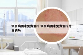 银屑病国家免费治疗 银屑病国家免费治疗是真的吗