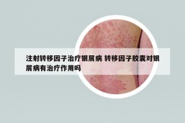 注射转移因子治疗银屑病 转移因子胶囊对银屑病有治疗作用吗