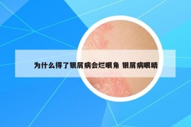 为什么得了银屑病会烂眼角 银屑病眼睛