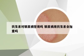 抗生素对银屑病管用吗 银屑病用抗生素会加重吗