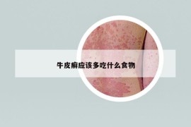 牛皮癣应该多吃什么食物