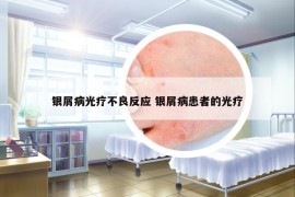 银屑病光疗不良反应 银屑病患者的光疗