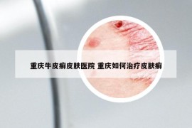 重庆牛皮癣皮肤医院 重庆如何治疗皮肤癣