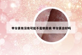 甲分离有没有可能不是银屑病 甲分离会好吗