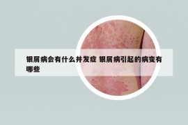 银屑病会有什么并发症 银屑病引起的病变有哪些