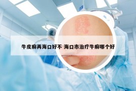 牛皮癣再海口好不 海口市治疗牛癣哪个好