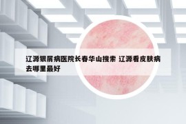 辽源银屑病医院长春华山搜索 辽源看皮肤病去哪里最好