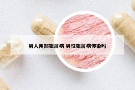 男人阴部银屑病 男性银屑病传染吗