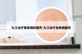 九江治疗银屑病的医院 九江治疗皮肤病医院