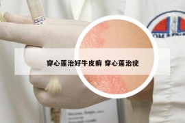 穿心莲治好牛皮癣 穿心莲治疣