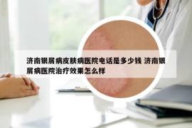 济南银屑病皮肤病医院电话是多少钱 济南银屑病医院治疗效果怎么样