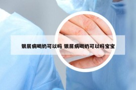 银屑病喝奶可以吗 银屑病喝奶可以吗宝宝