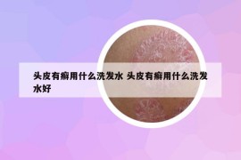 头皮有癣用什么洗发水 头皮有癣用什么洗发水好