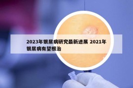 2023年银屑病研究最新进展 2021年银屑病有望根治