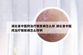 湖北省中医院治疗银屑病怎么样 湖北省中医院治疗银屑病怎么样啊