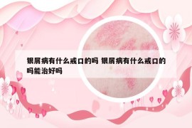 银屑病有什么戒口的吗 银屑病有什么戒口的吗能治好吗