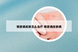 银屑病皮肤怎么治疗 银屑病皮肤病