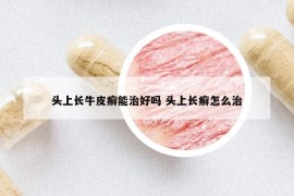 头上长牛皮癣能治好吗 头上长癣怎么治
