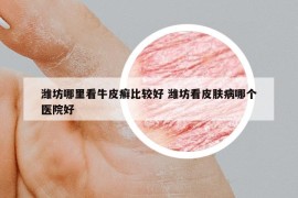 潍坊哪里看牛皮癣比较好 潍坊看皮肤病哪个医院好