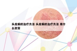 头皮癣的治疗方法 头皮癣的治疗方法 用什么软膏