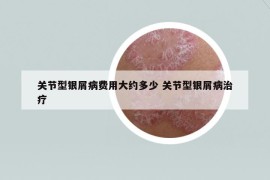 关节型银屑病费用大约多少 关节型银屑病治疗