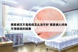 银屑病又不是癌症怎么治不好 银屑病人终身不得癌症的因果