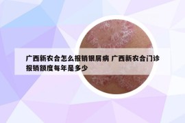 广西新农合怎么报销银屑病 广西新农合门诊报销额度每年是多少