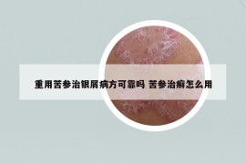 重用苦参治银屑病方可靠吗 苦参治癣怎么用