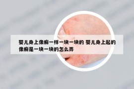 婴儿身上像癣一样一块一块的 婴儿身上起的像癣是一块一块的怎么弄