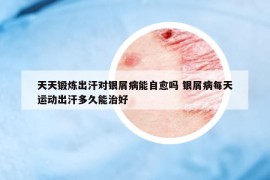 天天锻炼出汗对银屑病能自愈吗 银屑病每天运动出汗多久能治好