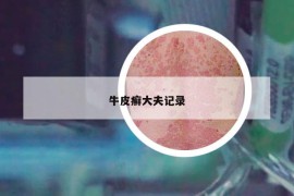 牛皮癣大夫记录