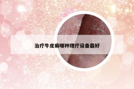 治疗牛皮癣哪种理疗设备最好