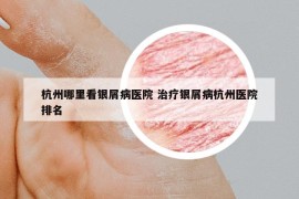 杭州哪里看银屑病医院 治疗银屑病杭州医院排名
