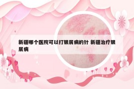 新疆哪个医院可以打银屑病的针 新疆治疗银屑病