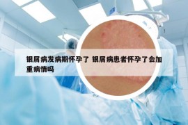 银屑病发病期怀孕了 银屑病患者怀孕了会加重病情吗