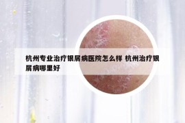 杭州专业治疗银屑病医院怎么样 杭州治疗银屑病哪里好