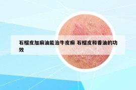 石榴皮加麻油能治牛皮癣 石榴皮和香油的功效