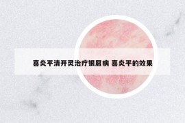 喜炎平清开灵治疗银屑病 喜炎平的效果
