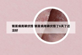银屑病用碘伏擦 银屑病用碘伏擦了6天了还没好