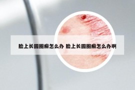 脸上长圆圈癣怎么办 脸上长圆圈癣怎么办啊