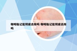 咖啡胎记能彻底去除吗 咖啡胎记能彻底去除吗