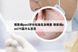 银屑病pasi评分标准出自哪里 银屑病pasi75是什么意思
