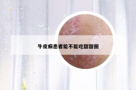 牛皮癣患者能不能吃甜甜圈