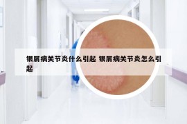 银屑病关节炎什么引起 银屑病关节炎怎么引起