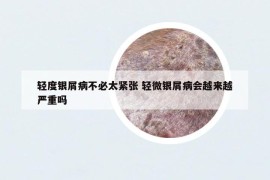 轻度银屑病不必太紧张 轻微银屑病会越来越严重吗