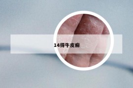 14得牛皮癣